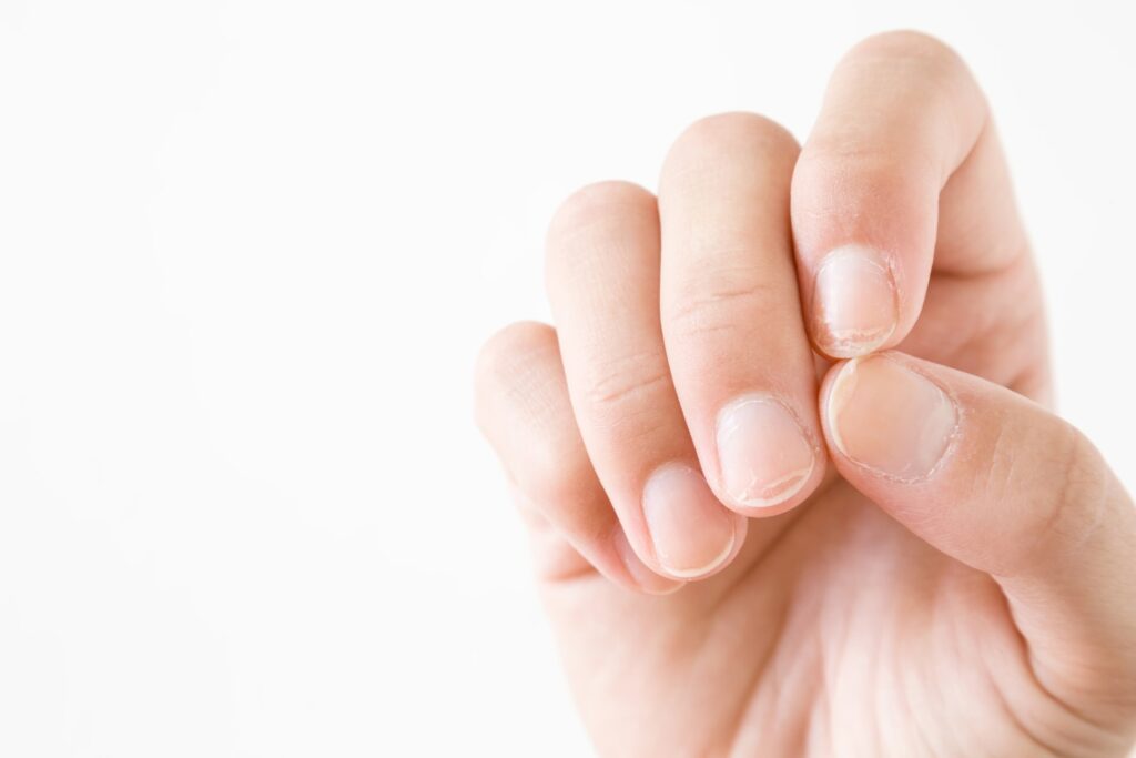A person positioning their fingers to show the viewer the kinds of damage across all of their nail surfaces.