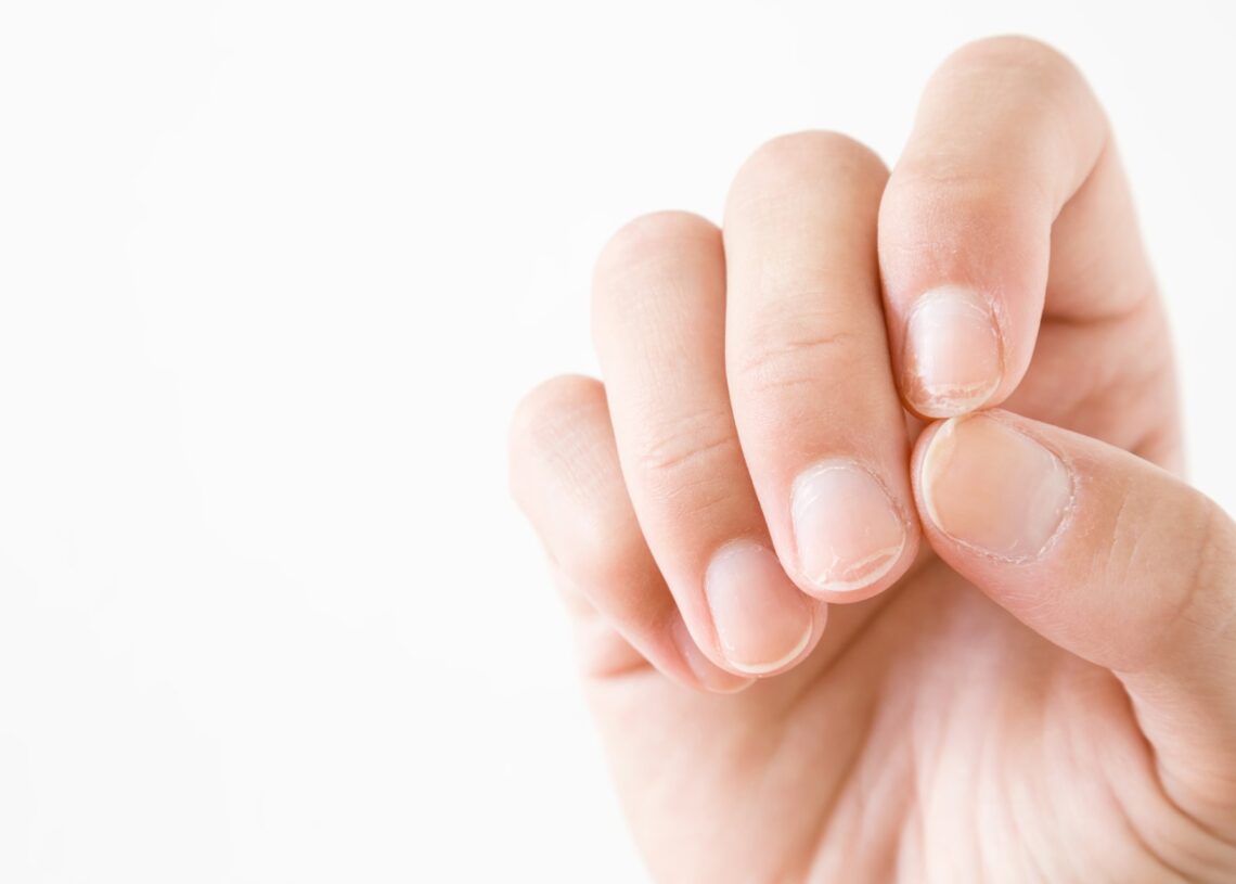 A person positioning their fingers to show the viewer the kinds of damage across all of their nail surfaces.